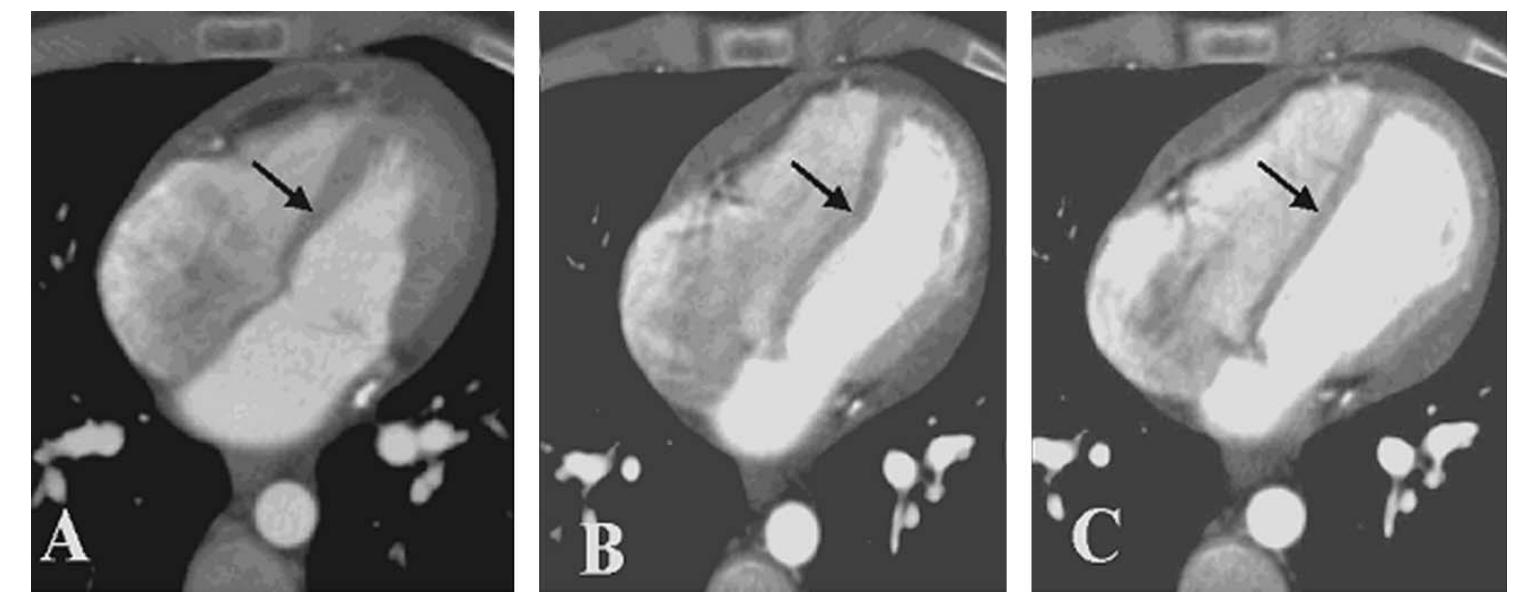 Tricular (PDF) Septal Bounce in Constrictive Pericarditis