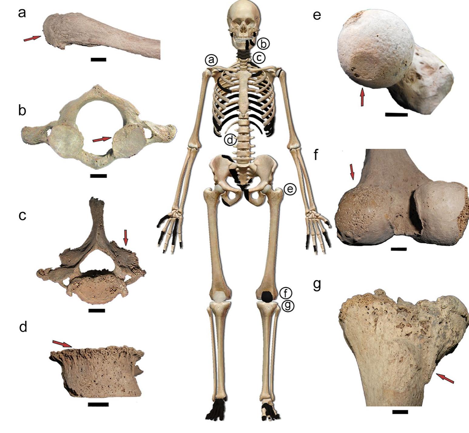 The age-at-death estimation was carried out by observing two regions of the os coxae: the auricular surface (Lovejoy et al. 1985) and the pubic symphysis (Todd 1921; Brooks and Suchey 1990). Complementarily, the cranial sutures were inspected (Meind] and Lovejoy 1985), and the erup- tion of the third molar was checked to have a broad esti- mate. The determination of the sex was made using the cranial morphology (Buikstra and Ubelaker 1994) and two regions of the os coxae, the greater sciatic notch (Buik- stra and Ubelaker 1994) and the pubic region (Phenice 1969). General osteological analysis was carried out by direct visual inspection with a cold-light bifocal loupe (110 mm) in search of osseous modifications. Standardized procedures were utilized to record pathological features in joint areas — degenerative joint disease (DJD) — (Buik- stra and Ubelaker 1994), traumatic injuries (Lovell and Grauer 2019), and other osteological modifications such as entheseal changes (entheseal robusticity from Mariotti et al. (2007) and Coimbra method from Henderson et al. (2016)). To perform the differential diagnosis by defining the type and aetiology of the traumatic injuries, bioar- chaeological and modern clinical literature was surveyed   The individual NM3_4 was estimated to be a 30—39-year- old adult male with excellent preservation and anatomi- cal completeness. Only a few bones are missing, such as some cervical vertebrae, ribs, and elements of hands and feet (Fig. 2) (see details in Prates et al. (2019)). Different regions of the skeleton (vertebral column, upper and lower limbs) show osseous modifications compatible with DJD, traumatic injuries, and entheseal changes. 