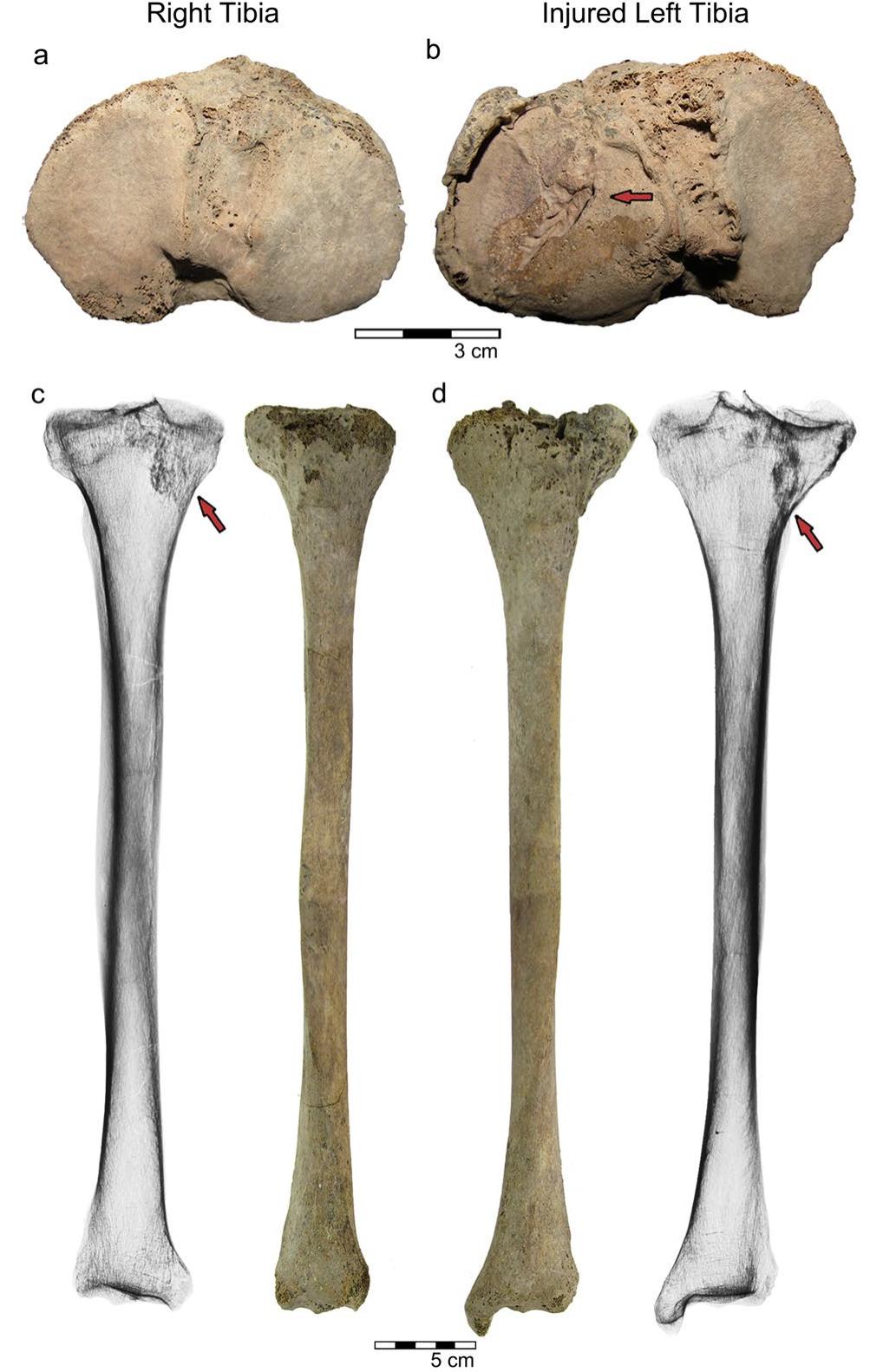 Fig.3 Comparison between the right tibia (left column) and the left tibia (right column). A Right tibia, proximal view. B Left tibia, proximal view. The arrow indicates the groove in the LTPF plane. C Anterior view, the arrow indicates the denser trabecular bone of the medial condyle. D Anterior view, the arrow indicates the callus 