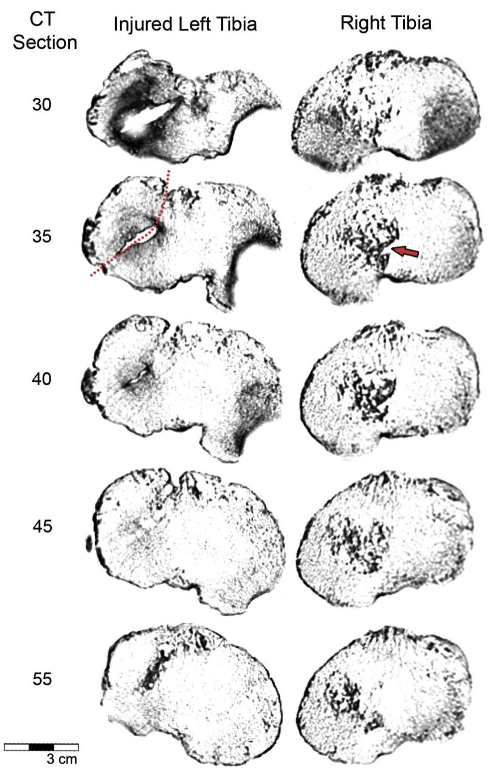 Fig.4 Computed tomography sections (CT section) of the injured left tibia (left side) and the non-injured right tibia (right side) in proxi- mal view. In the left tibia, the dotted line delimits the fracture plane observed in the lateral condyle, and as the sections go deeper, the remodelling callus can be distinguished. In the right tibia, the arrow indicates how the trabecular bone of the medial condyle is denser than that observed in the left tibia 
