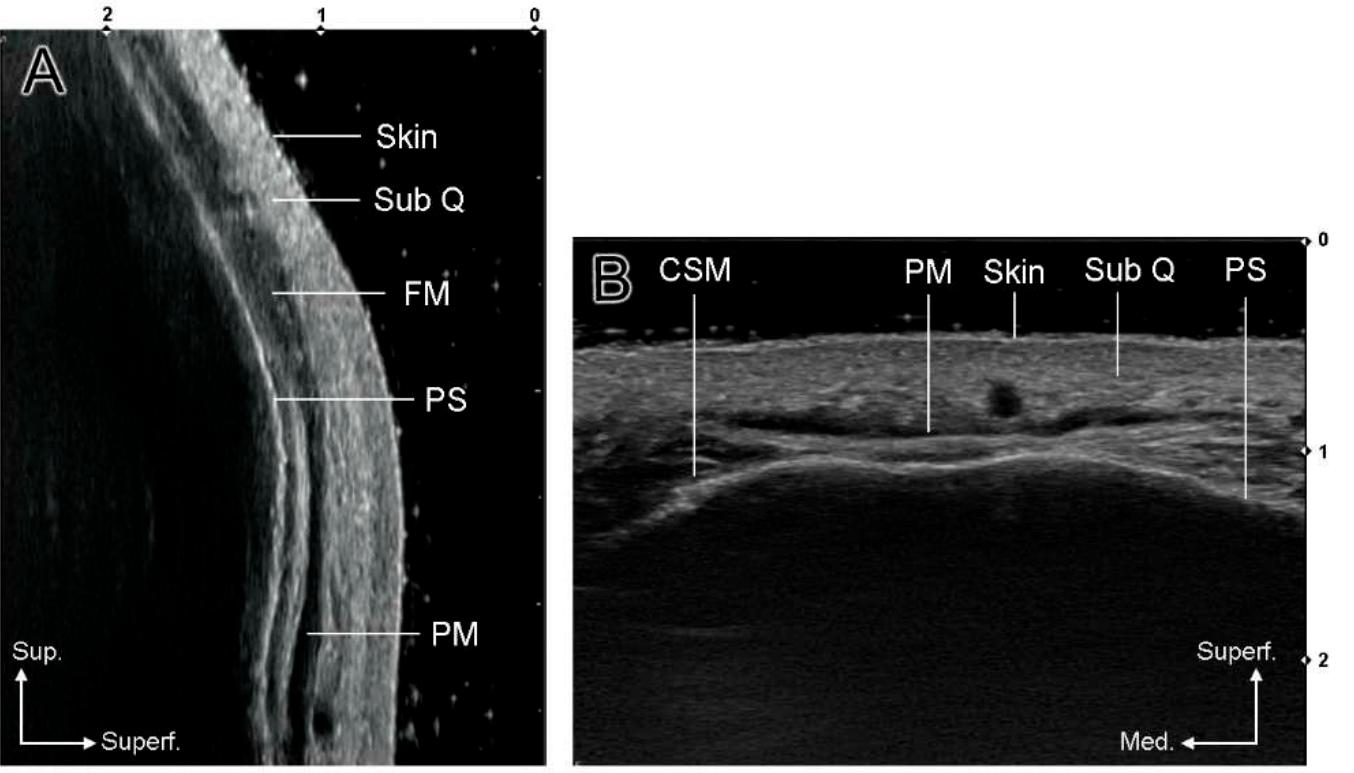 (PDF) Anatomical Injection Guidelines for Glabellar Frown Lines Based ...