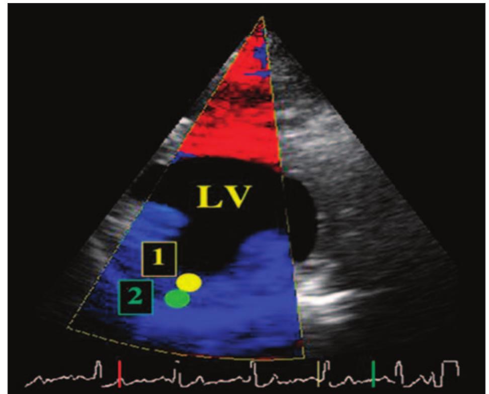 (PDF) Use of quantitative two-dimensional color tissue Doppler imaging ...
