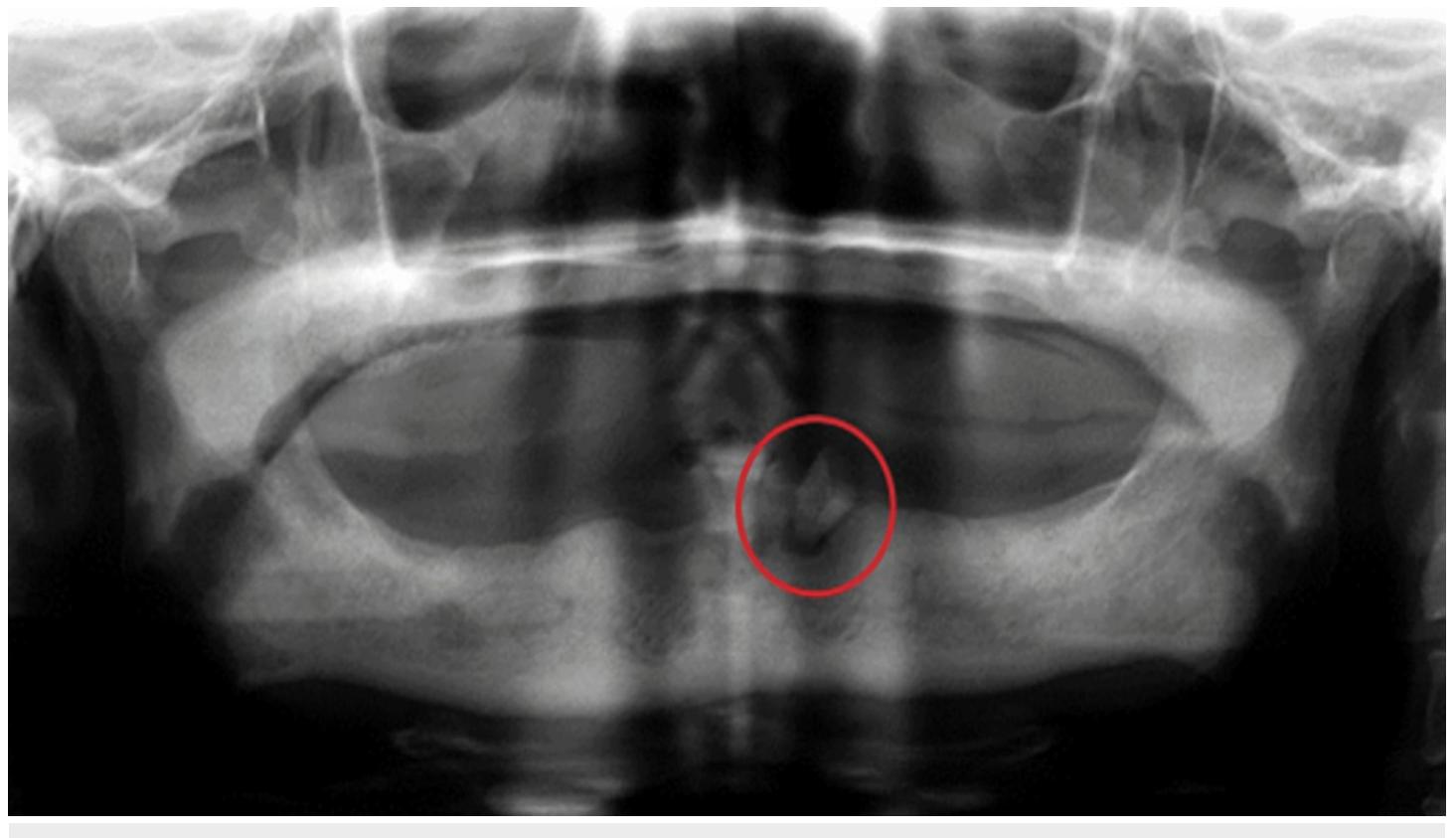 Retained Roots Radiograph (PDF) Prevalence of Total Edentulism and Panoramic Radiographic ...