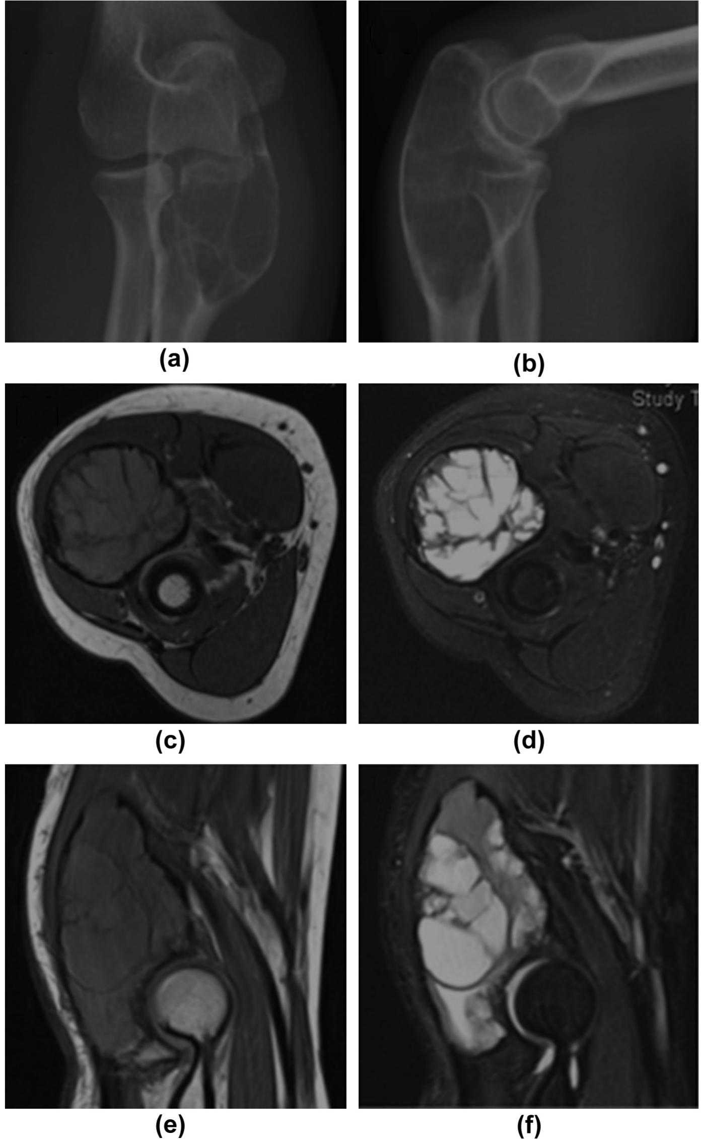 Aneurysmal bone cyst in a 12-year-old female patient.