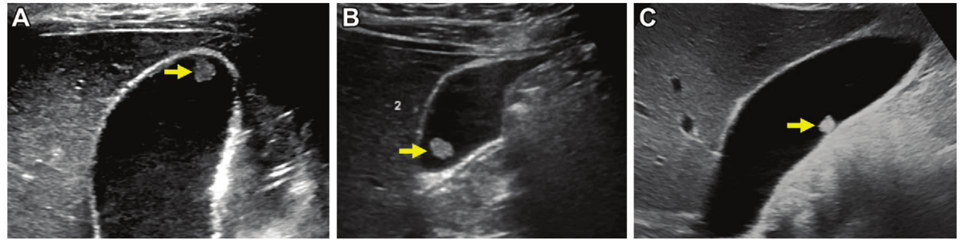 Figure 13 - from Gallbladder polyps ultrasound: what the