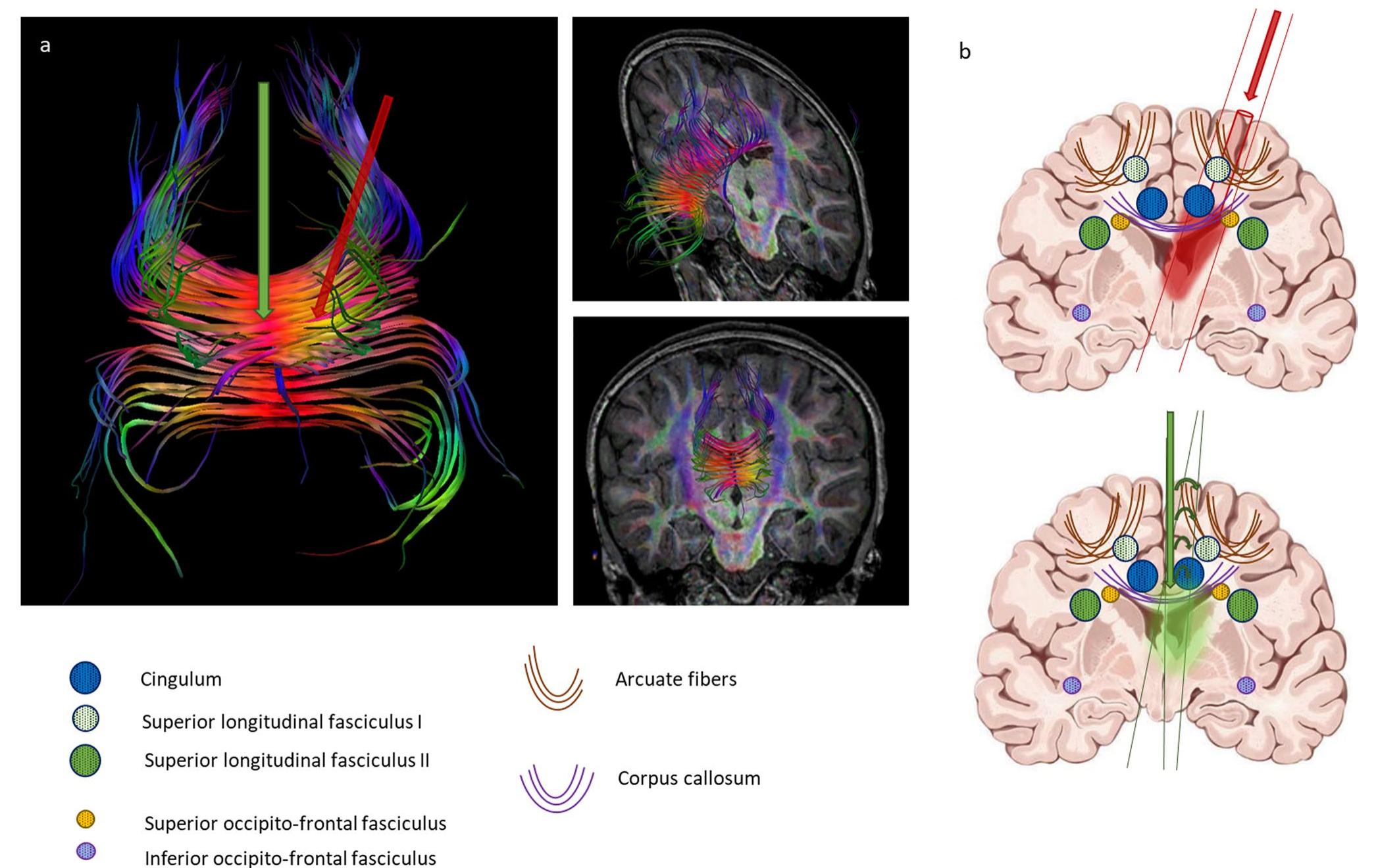 (PDF) Preservation of frontal white matter tracts in ventricular ...