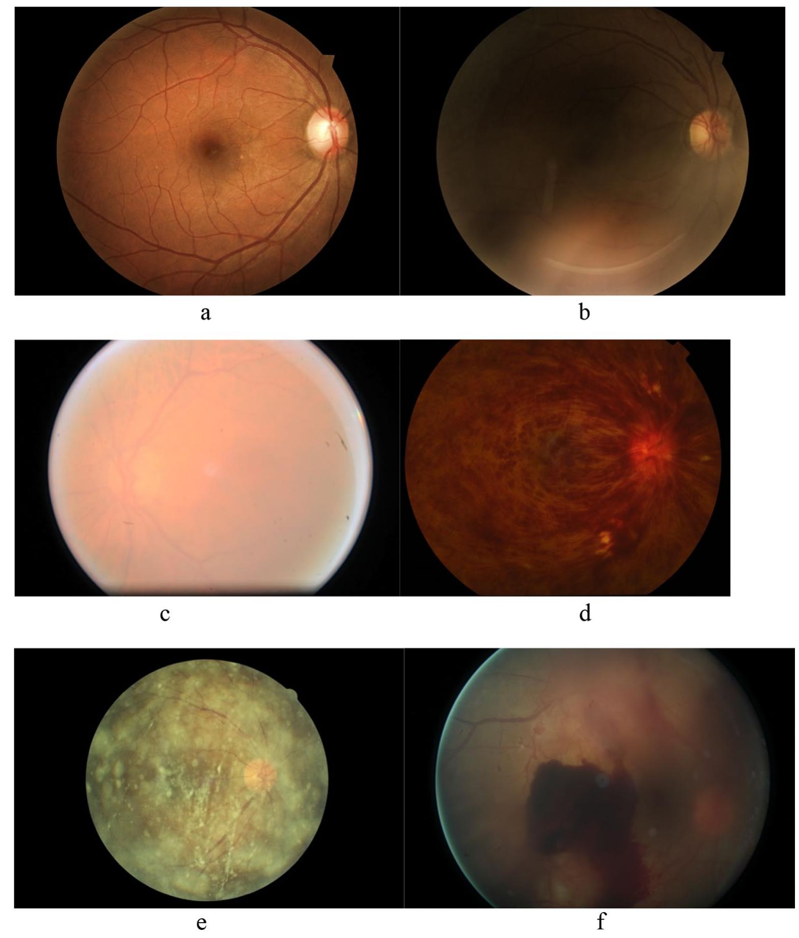(PDF) Assessment of image quality on color fundus retinal images using ...