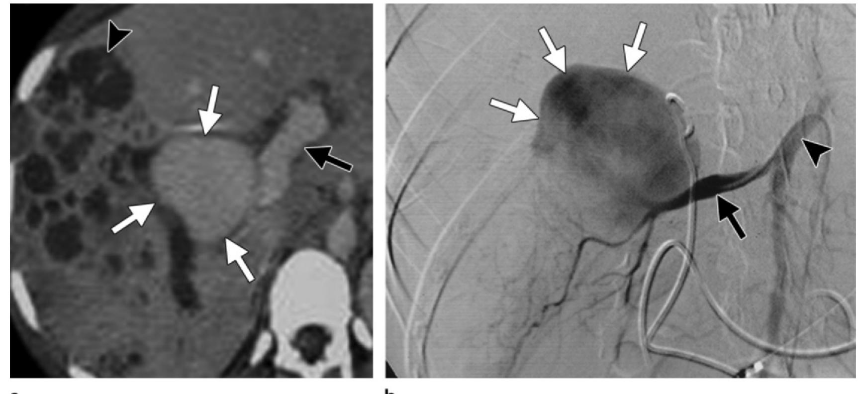 (PDF) Imaging of the Porta Hepatis: Spectrum of Disease