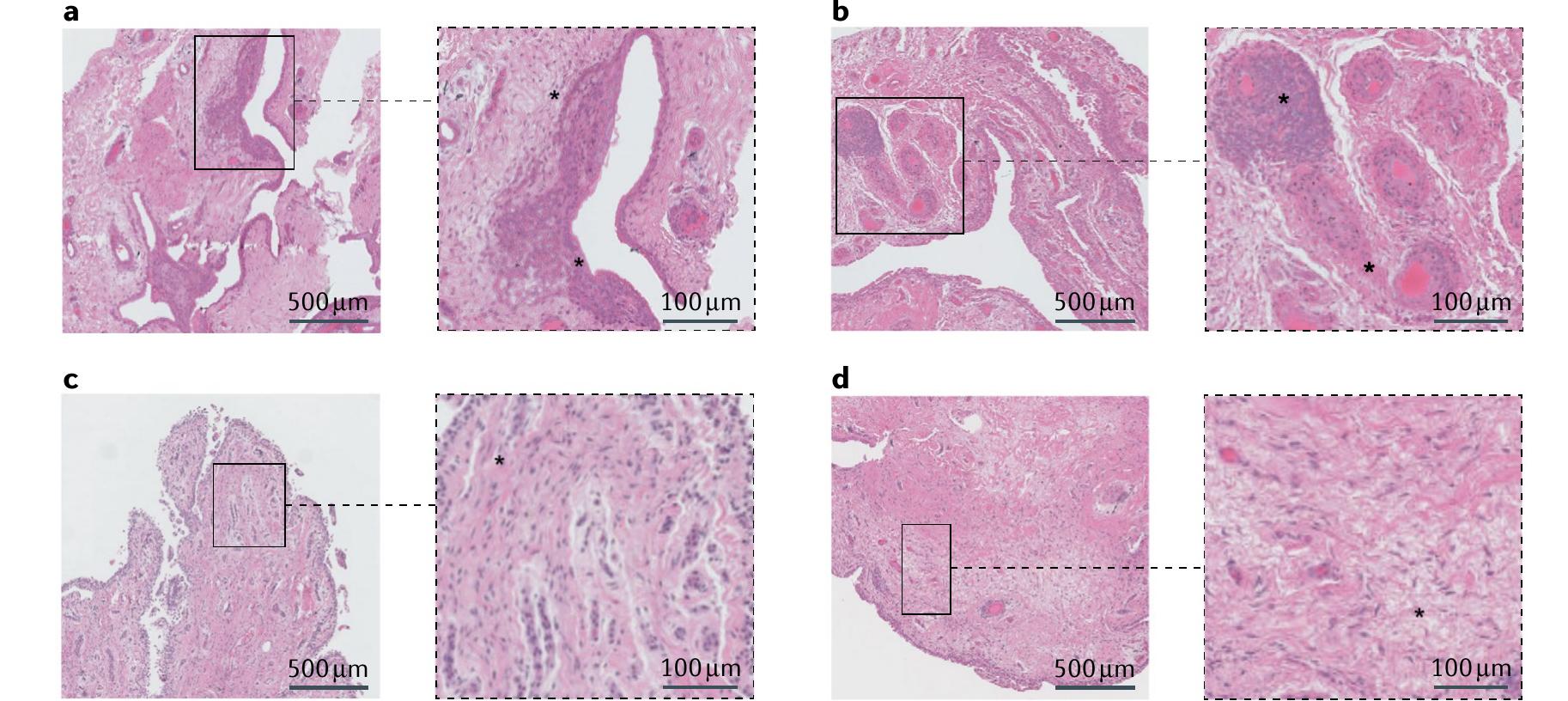 (PDF) Synovial inflammation in osteoarthritis progression