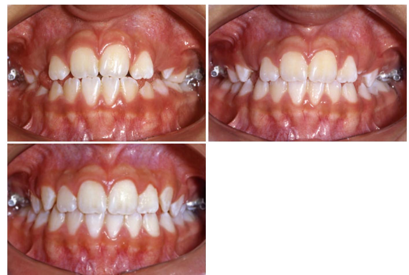 Spur Rst S. 3.67, 3.68, and 3.69 progress intraoral photographs taken