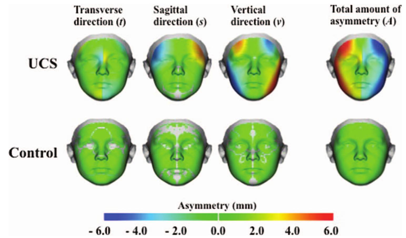 (PDF) Facial Asymmetry in Children with Unicoronal Synostosis who have ...