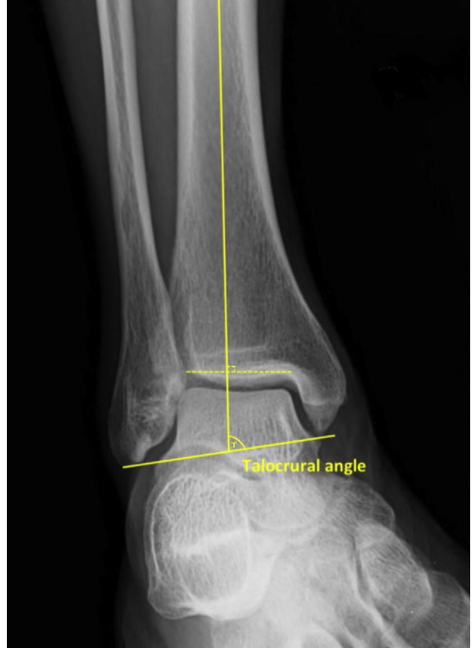 Talocrural Inversion (PDF) Radiographic parameters in gravity stress view of the ankle ...