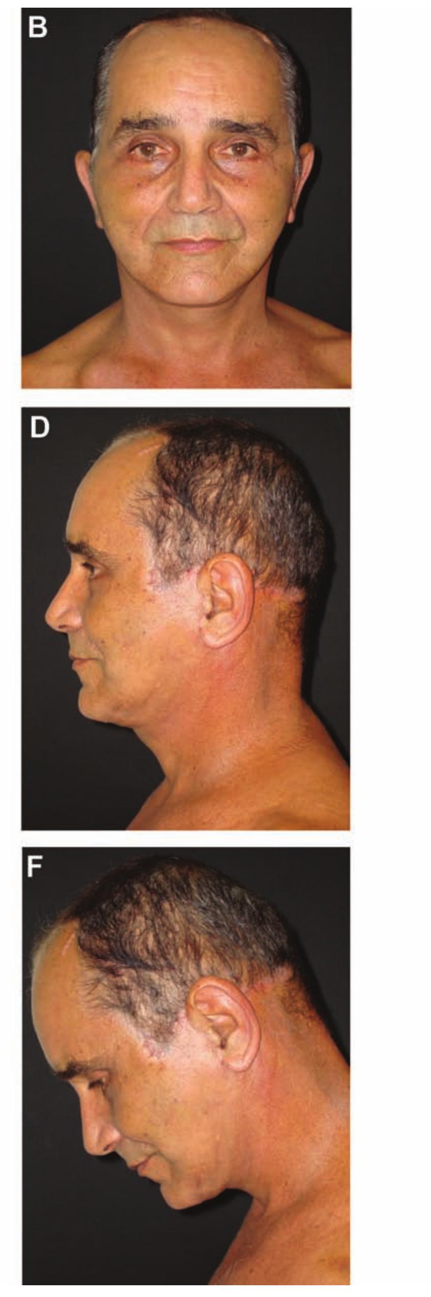 (PDF) Triple Suture for Neck Contouring: 14 Years of Experience