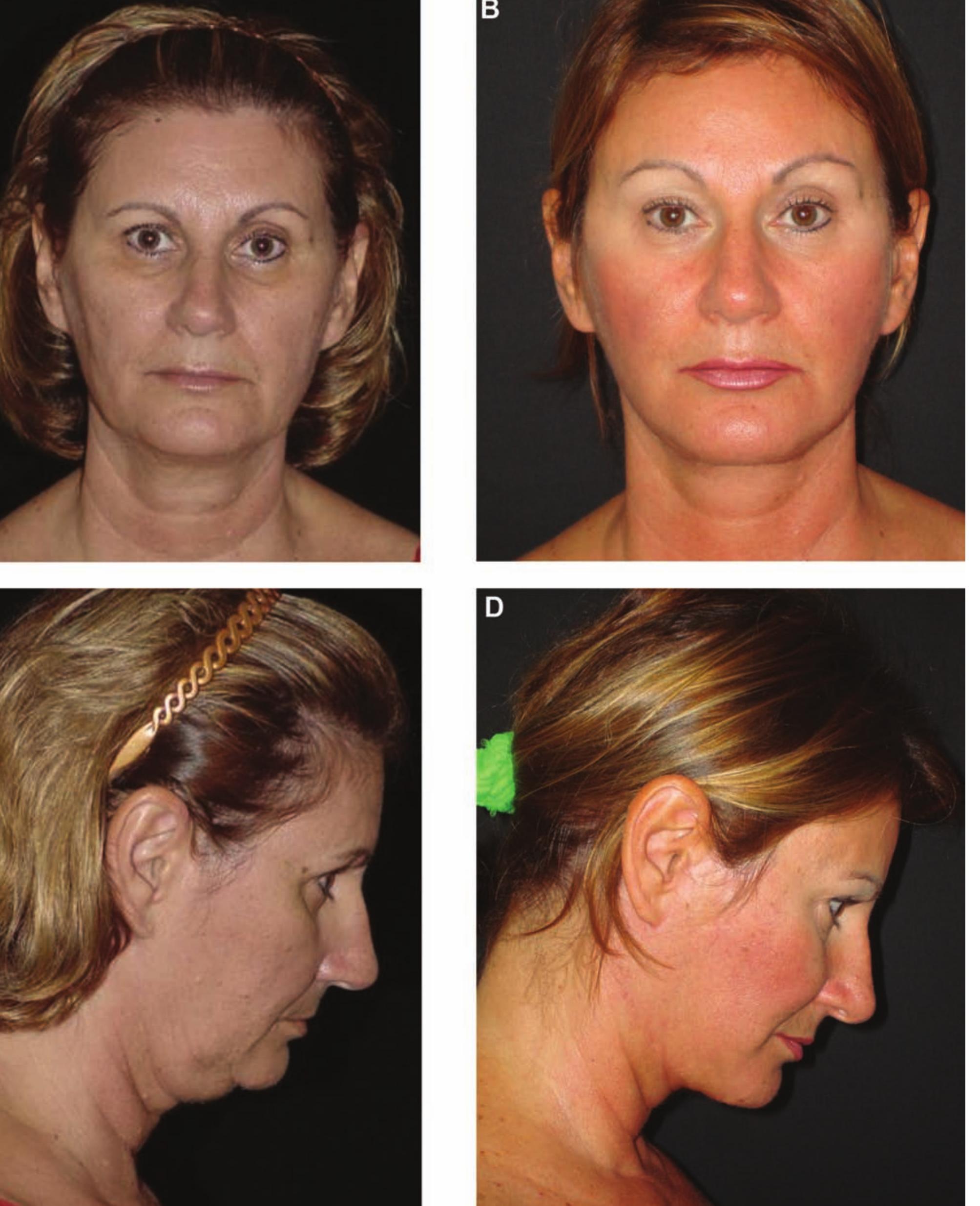 (PDF) Triple Suture for Neck Contouring: 14 Years of Experience