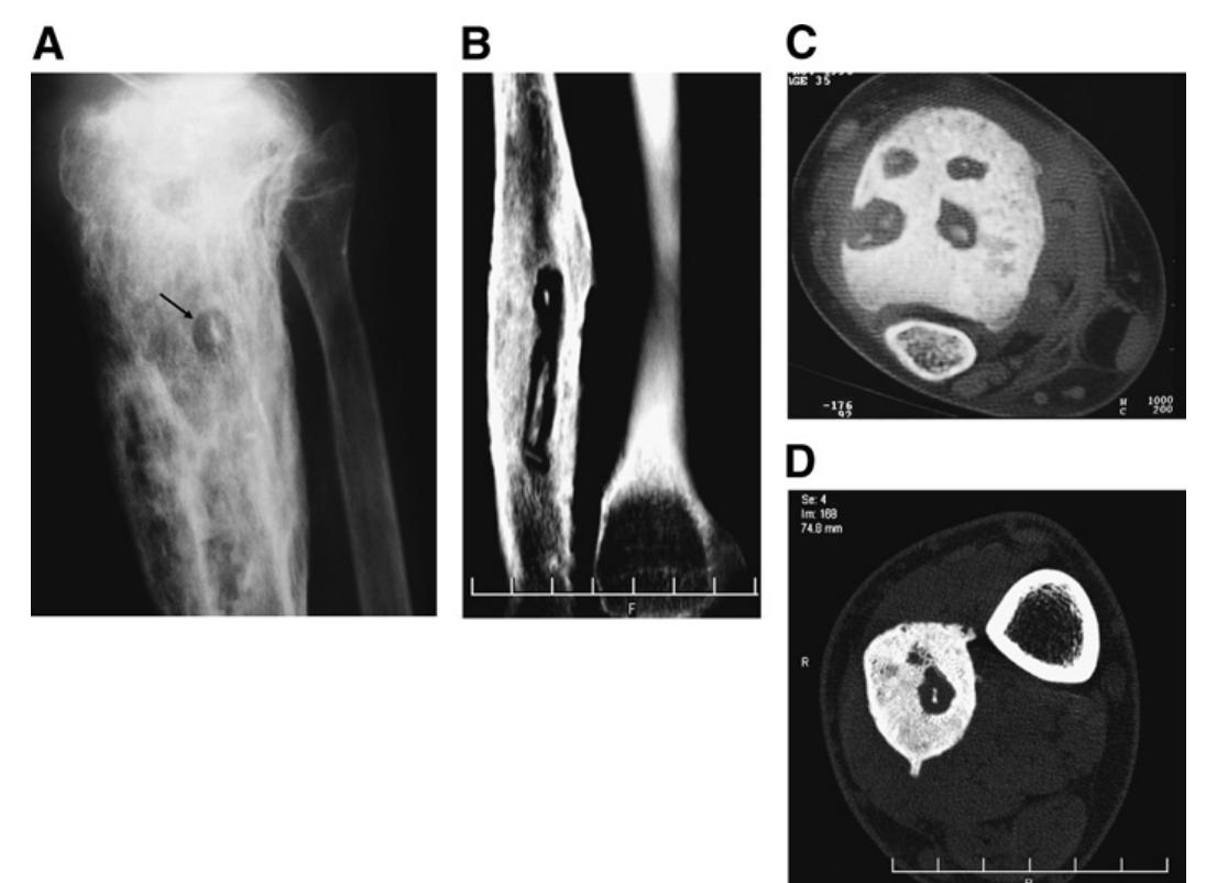 Figure 15 - from Imaging of Osteomyelitis: Current Concepts