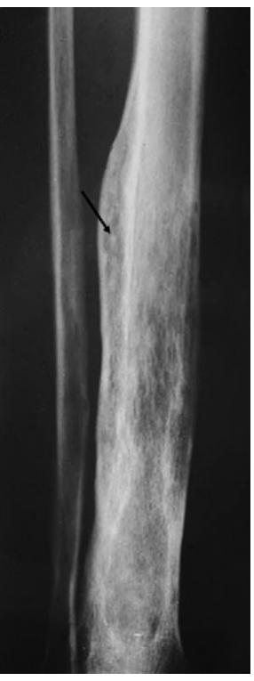 Figure 1 - from Imaging of Osteomyelitis: Current Concepts