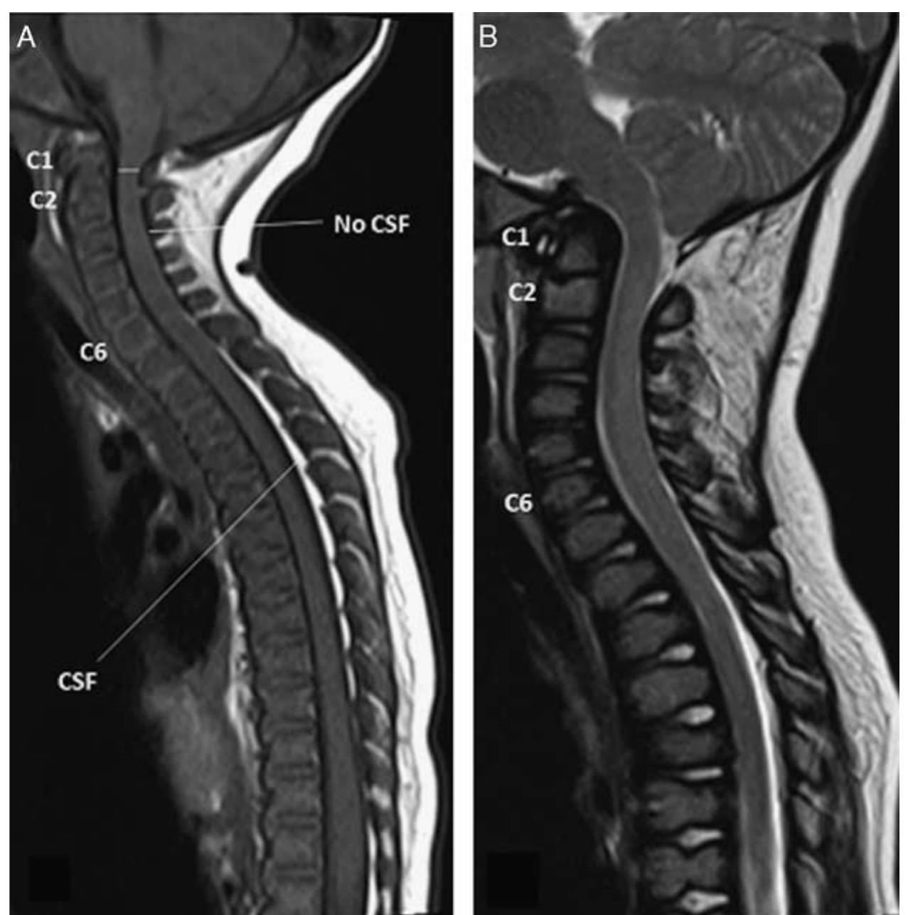 (PDF) Cervical Spine Deformities in Children With Rhizomelic ...