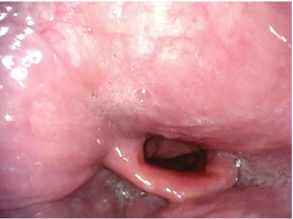 (PDF) Case Report of a Massive Retropharyngeal Goiter Resulting in ...