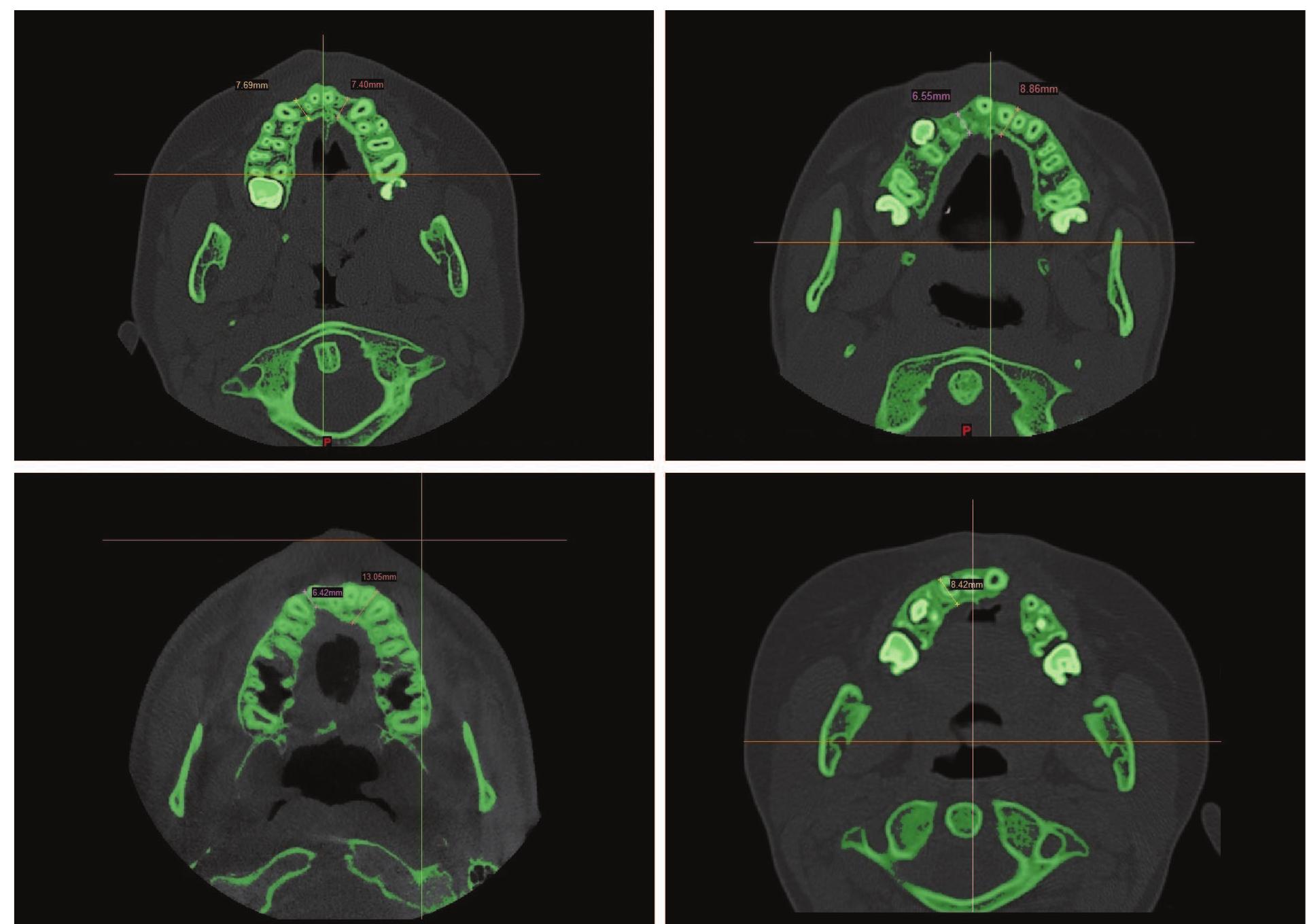 Cleft Bone (PDF) Long-Term Computed Tomographic Evaluation of Alveolar Bone ...