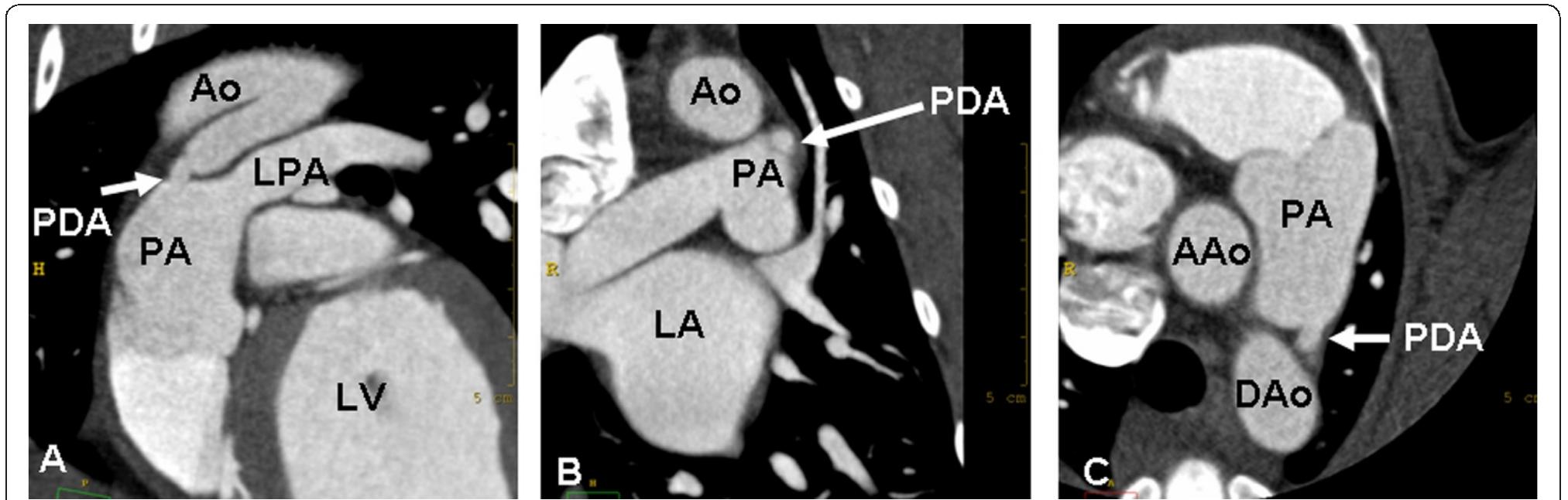 Praa Radiograph (PDF) Multidetector-row computed tomography of thoracic aortic ...