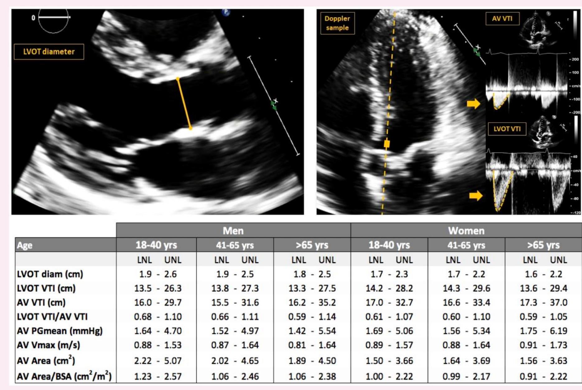 (PDF) Normative values of the aortic valve area and Doppler ...