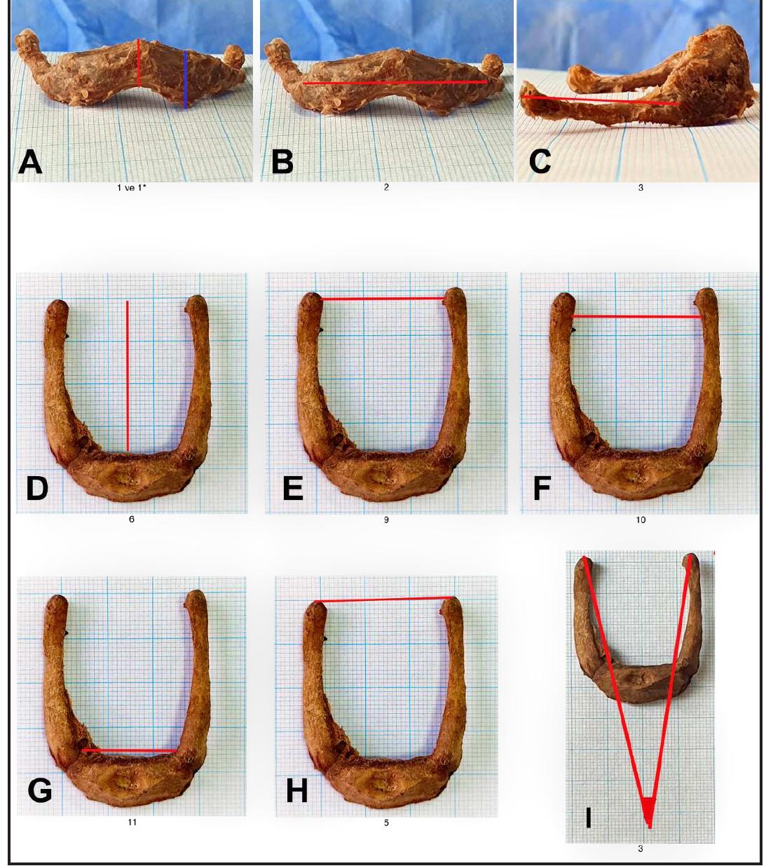 (PDF) Morphological and Morphometric Variations of the Hyoid Bone in ...