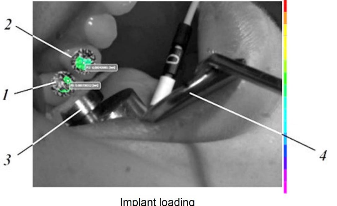 Figure 1. The Implant’s loading capture: 1—loaded tooth (implant); 2—unloaded tooth (natural tooth); 3—load cell; 4—Farabeuff retractor.  On the vestibular surface of the dental crown and the dental implant, which were going to be monitored, sets of black dots with random size and distribution were applied corresponding to the followed area of interest for the selected characteristics of the optical system used for the experiment (zones with the black dots can be seen on Figures 1 and 2). 