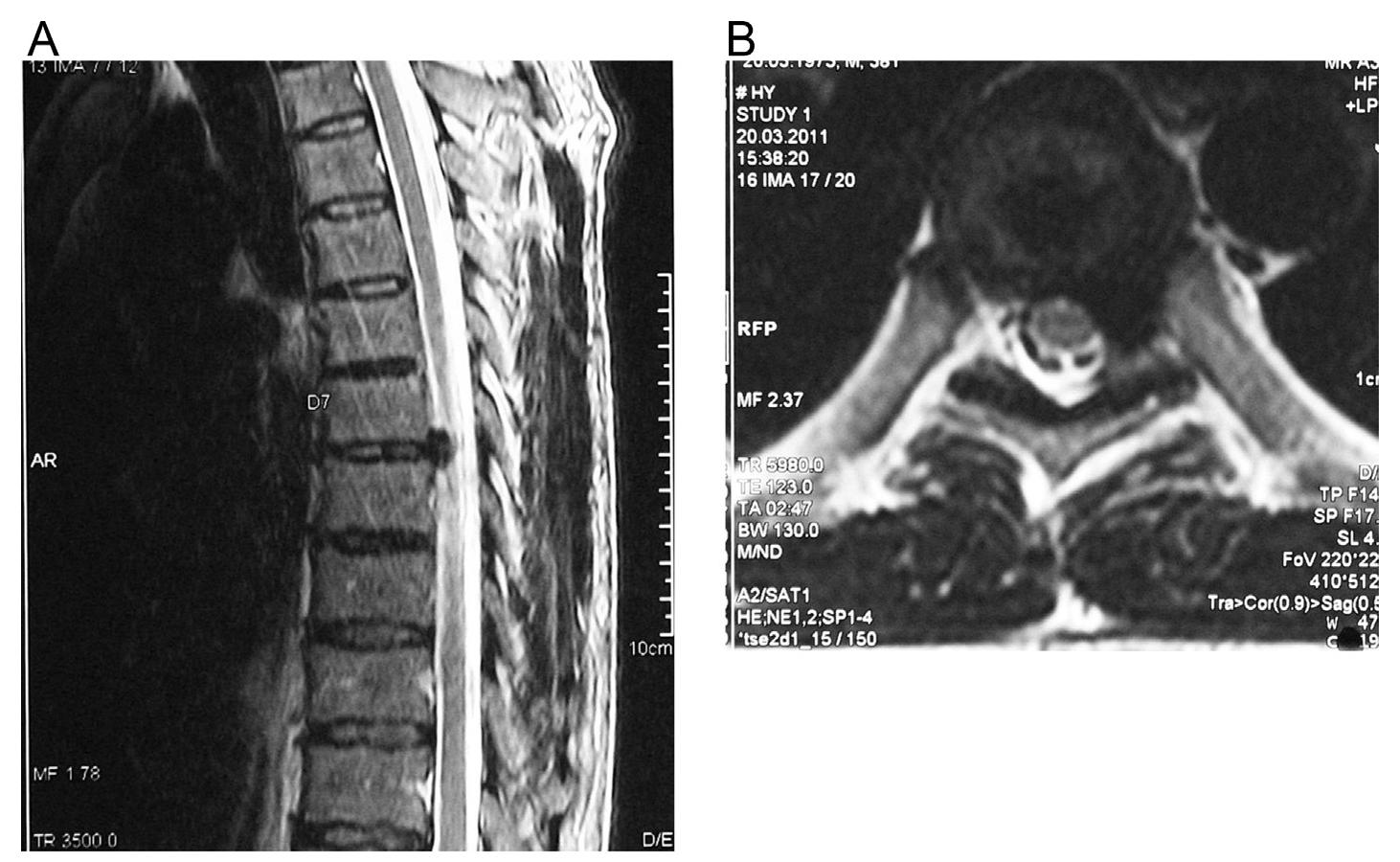 T2 Disc Figure 3 - from Regression of a symptomatic thoracic disc