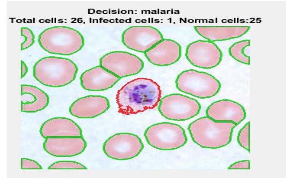 Color Alaria (PDF) Malaria Detection Using ANN
