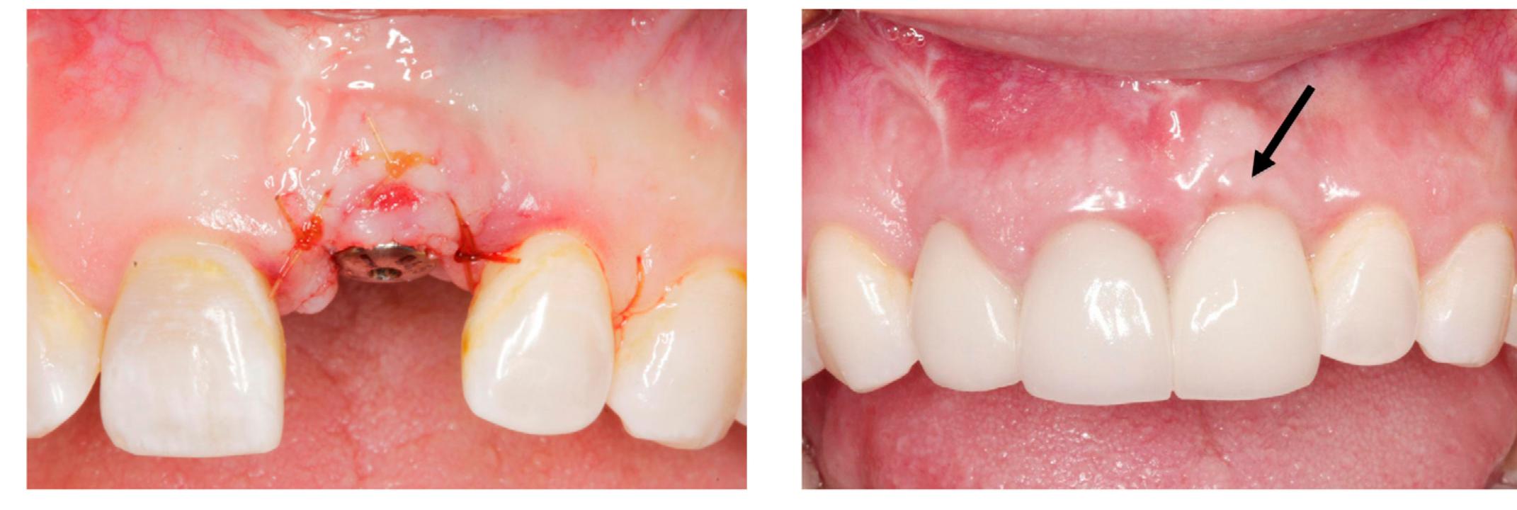 (PDF) Simplified Rolled Technique at Implant Uncovering Surgery for ...