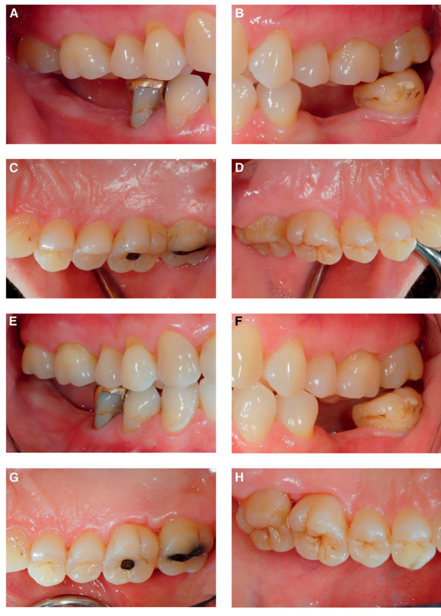 (PDF) Cervical Enamel Projections in Unusual Locations: A Case Report ...