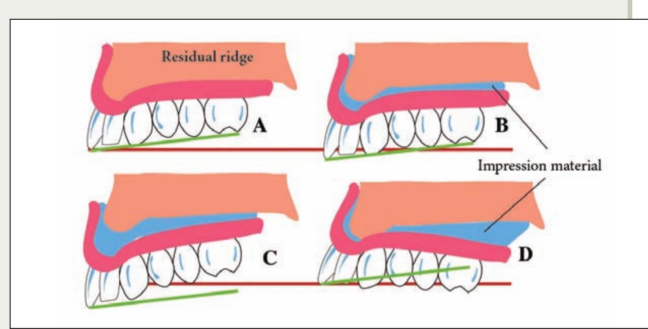 Figure 8 - from Improving the outcome of denture relining