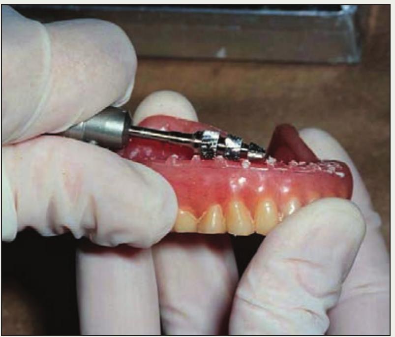 (PDF) Improving the outcome of denture relining