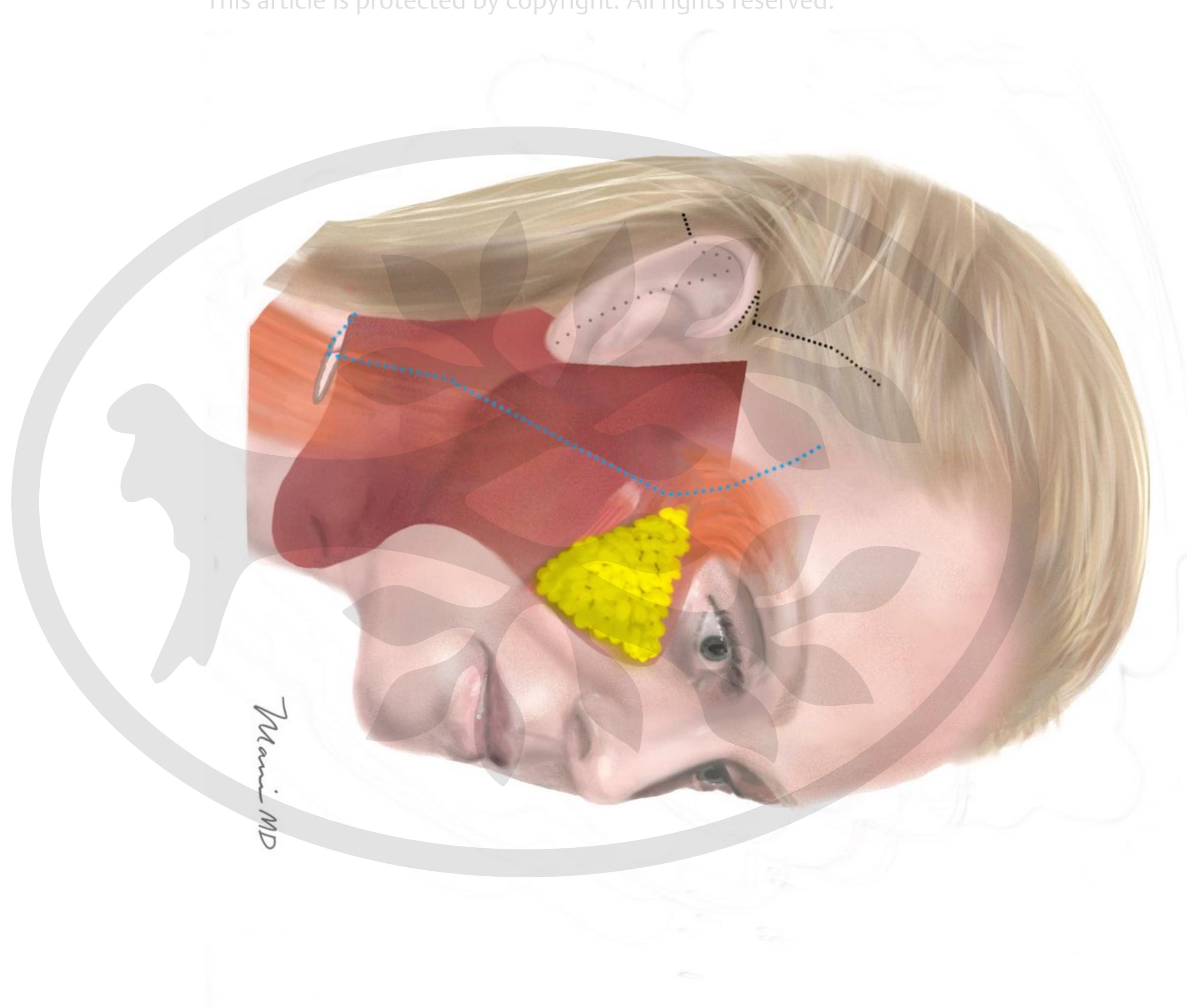 Figure 47 - Endoscopic, 