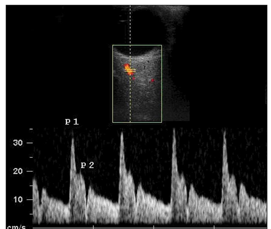 Figure 1 - from Doppler Velocimetry of the Ophthalmic Artery