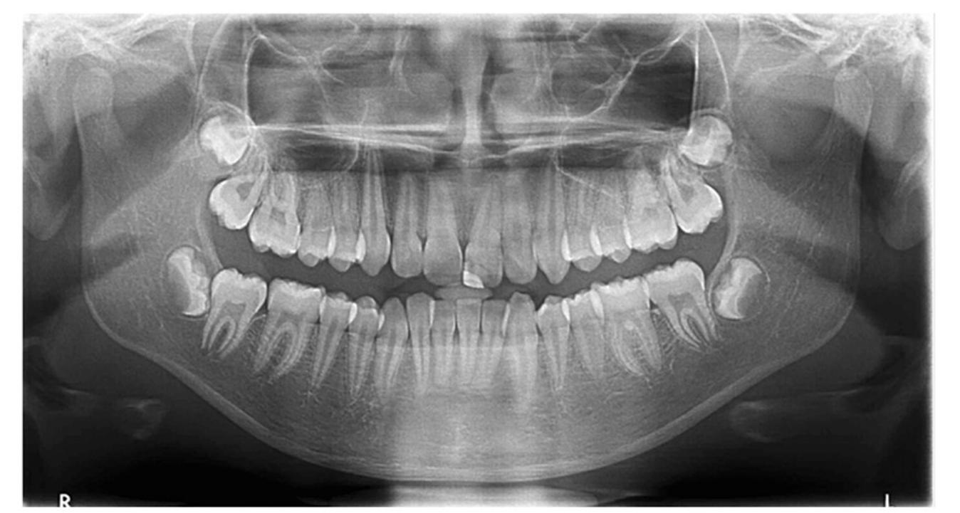 (PDF) Anatomical Variants of Condylar Process, Coronoid Process, and ...