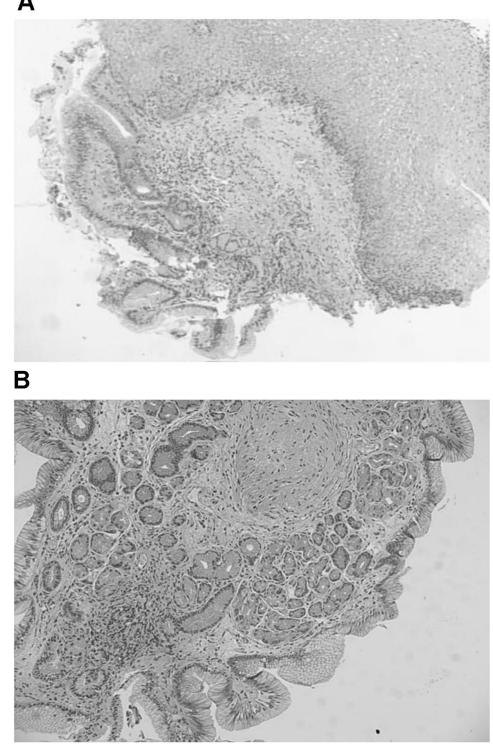 Net Inlet Patch (PDF) A rare association of inlet patch with laryngospasm