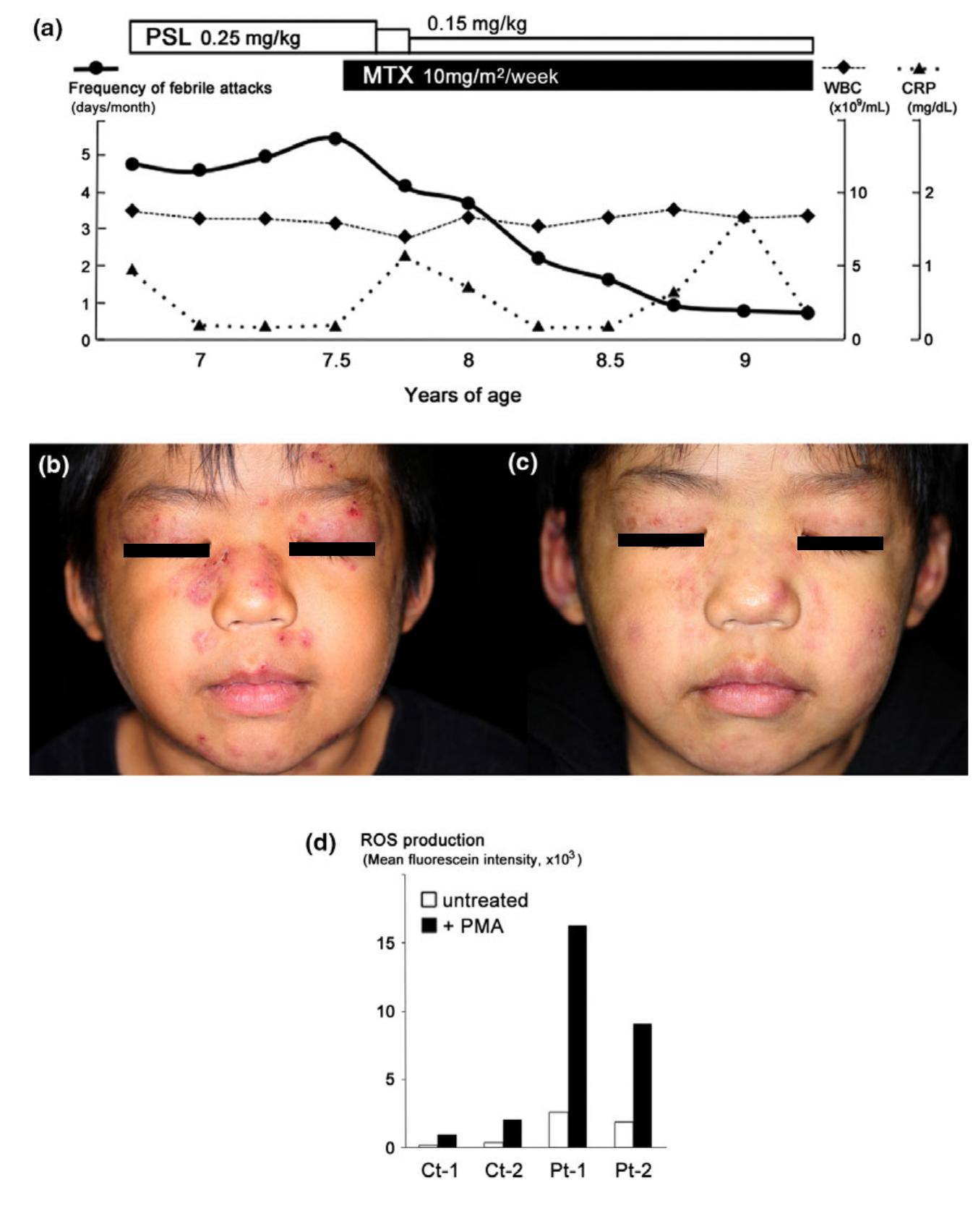 Nns Mutation (PDF) Beneficial effect of methotrexate on a child case of Nakajo ...