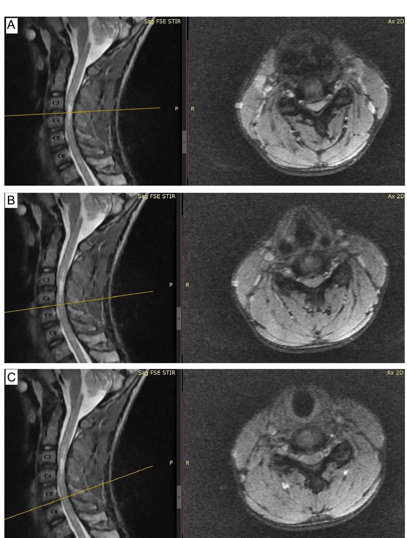(PDF) An unusual case of pediatric cervical myelopathy due to ...