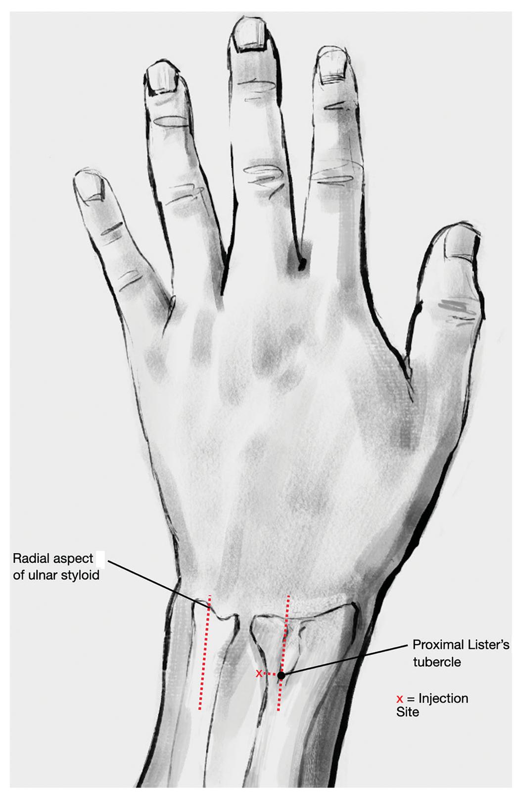 (PDF) Anatomic surface landmarks to guide injection for posterior ...