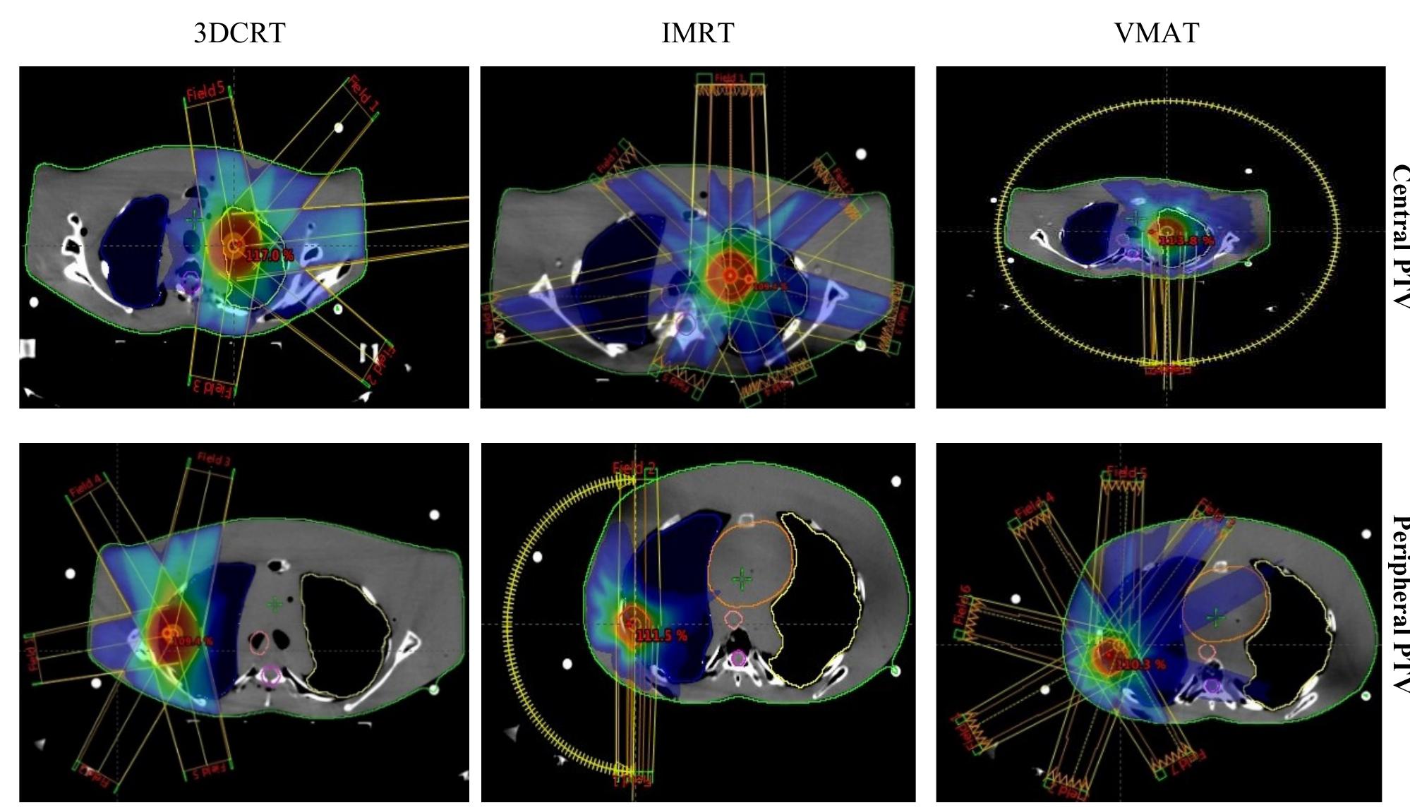 Axial Approach (PDF) Dosimetric Evaluation Study of 10-MV FFF Used in SBRT for Lung ...