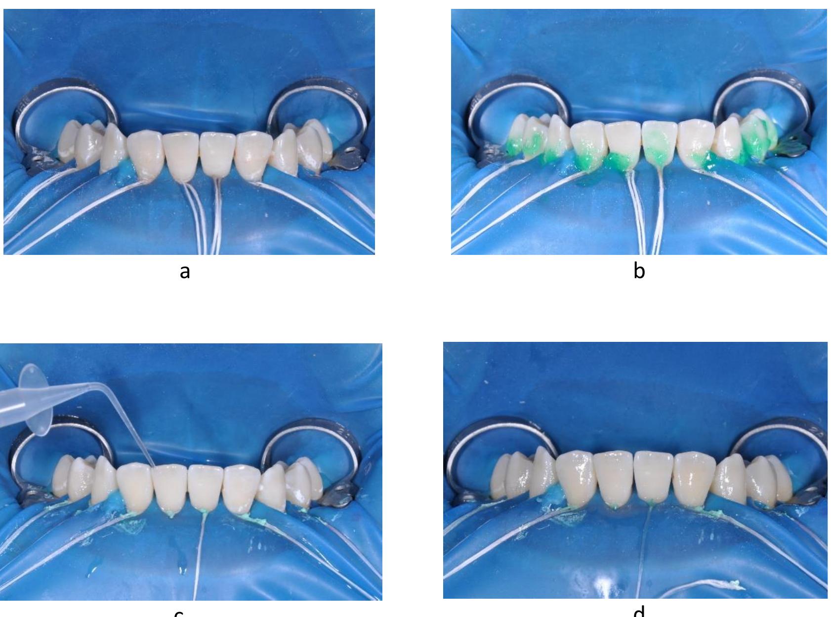 (PDF) The power of ICON infiltration in an adolescent patient. Case report