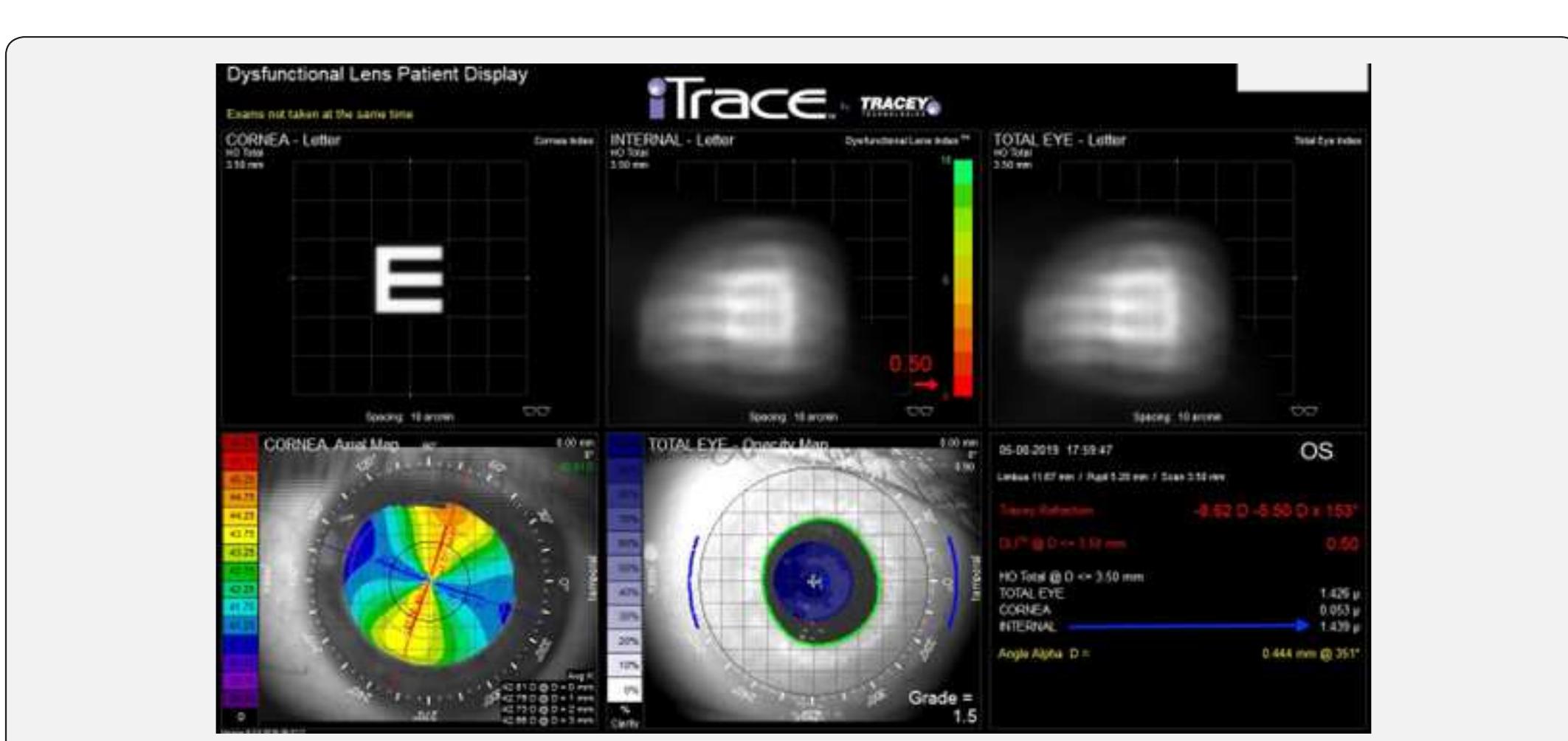 Figure 12 - from Congenital lens dysfunction as a new,