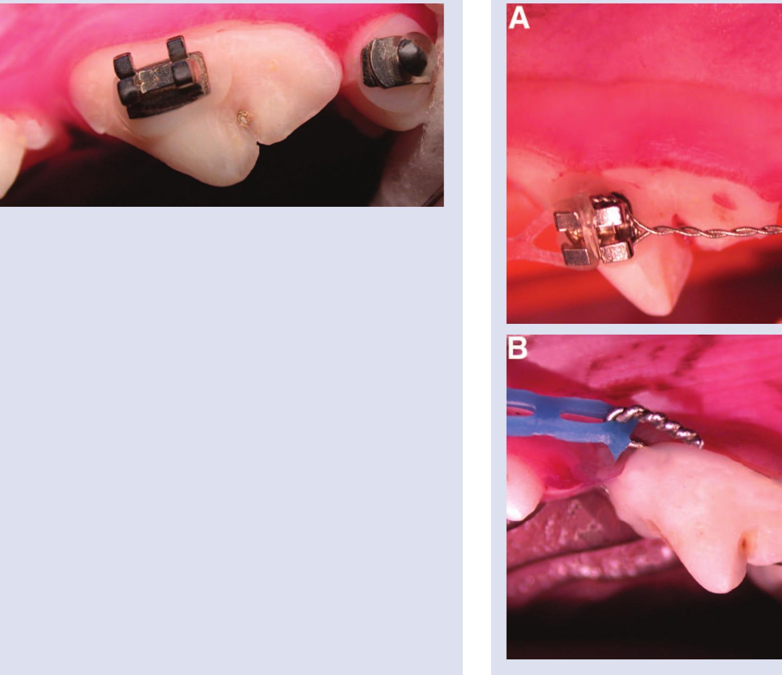 Figure 6 - Correction of Maxillary Canine Tooth Mesioversion