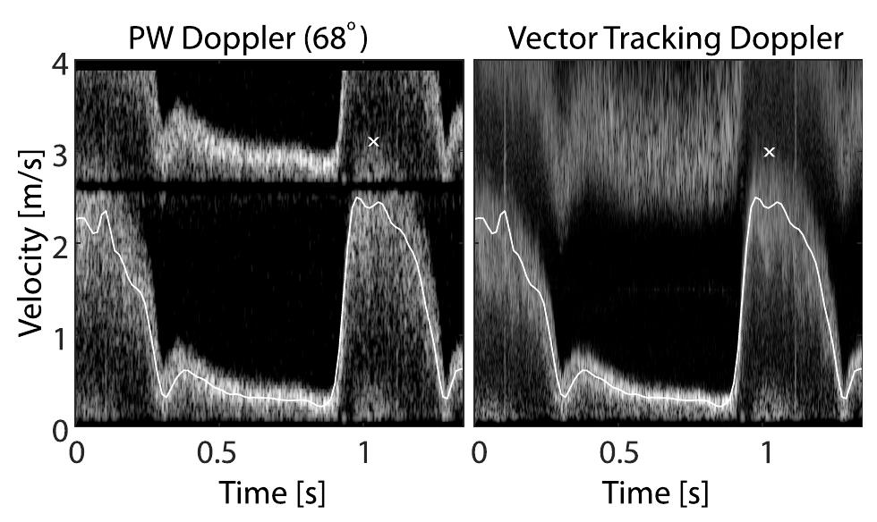 (PDF) Combined 2-D Vector Velocity Imaging and Tracking Doppler for ...