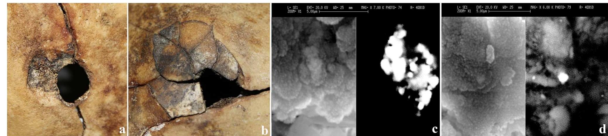 Fig. 1 Case 1—gunshot entry wound (a) on the parietal bone, gunshot exit wound (b), and residues of Pb found on both lesions (e, d 