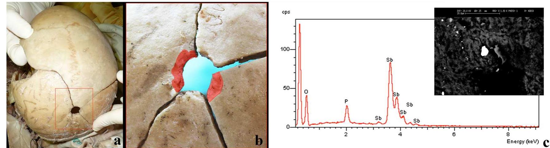 Fig. 2. Case 2—entrance gunshot wound on the sagittal suture (a), with “chipping” aspect in red (b); SEM-EDX aspect of metallic residue of Sb wit relative spectrum (c)  The skeletal remains of a victim of organized crime were found buried in the woods: they were unearthed and scattered by the local fauna, thus the grave and its content came to light. The case was rapidly linked to a settling of scores within the underworld. According to the confession of a penitent, the victim was executed with a shot in the head and then buried in the ground of a wood 2 years before he was discovered. Remains were scattered in an area of tens of meters because of the action of the local fauna, so they came to light only after a process of thorough sampling and sieving. Very little was left of the cranium (only a fragment of the right zygomatic   This case concerns the charred and extremely fragmented skeletal remains of a young man found in a quarry. According to the deposition of a friend, they were together about 15 days before in the quarry he owned when the victim suddenly drew his gun and shot himself in the temple; overwhelmed with 