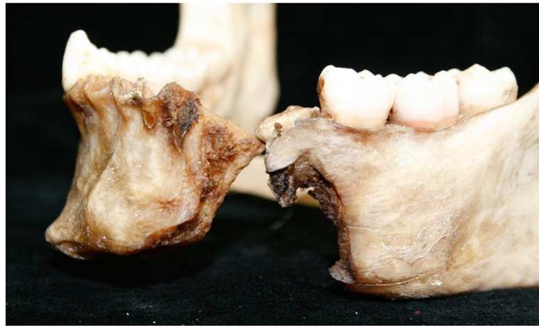 Fig. 3. Case 2—exit gunshot wound on the jaw  fear, he set the corpse alight and then buried it in the soil of the quarry. When some weeks later the remains came to light, only small fragments of the cranium were left, but they were enough to discredit the friend’s version thanks to crucial clues given by GSR testing with SEM-EDX. Remains were burnt, scattered, and partially buried inside the quarry; only the base of the skull, a burnt fragment of parietal, and a other segments from the postcranium were recovered (Fig. 5). Among the remains recovered, in fact, there was a charred fragment of the calvaritum with an incomplete and semicircular bevel-shaped esion whose incomplete and burnt nature requested further proof of its origin from a gunshot wound. SEM-EDX analysis around the suspect lesion showed the presence of a zinc (Zn) and copper (Cu) alloy whose composition was similar to the jacket of some bullets found in the suspect’s house. No such residues were found on other bone fragments and in the soil from the quarry. The version of the suspect became thus doubtful: he stated that his friend shot himself in the temple, but evidence was in contrast because of the position of the gunshot wound in the calvarium. The lesion found was in fact  