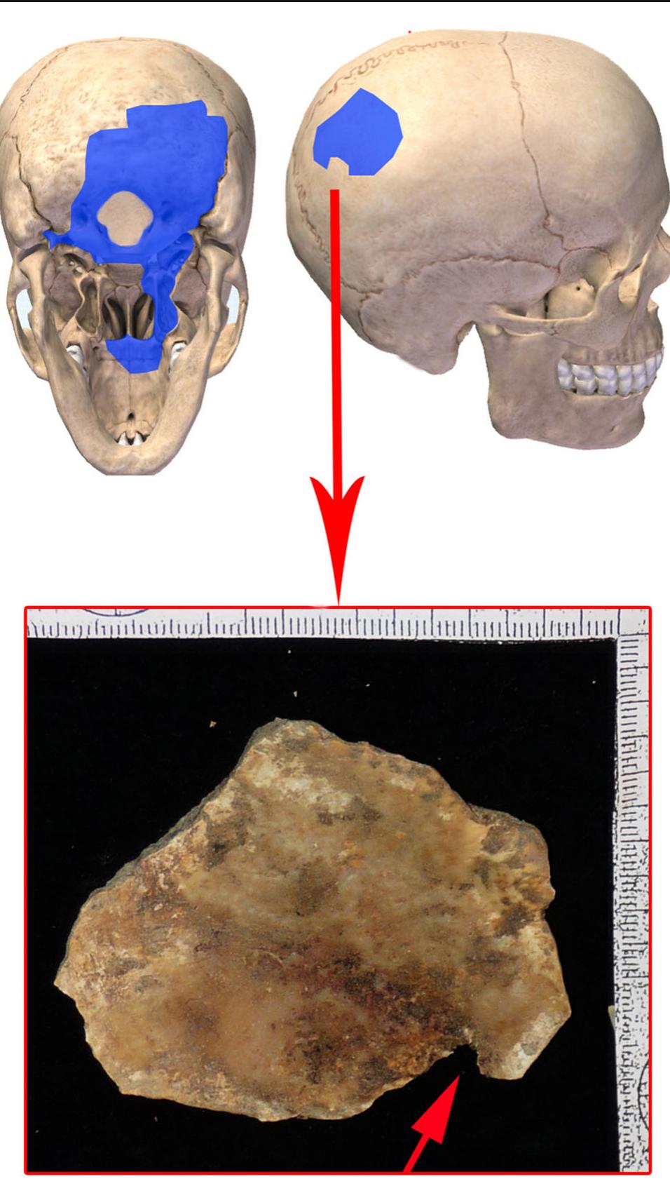 Fig. 5 Case 4—parietal fragment with suspected partial gunshot entry wound (red arrows)  sodium rhodizonate detected the presence of GSR, thus dem- onstrating the persistence of these residues even in the partic- ular conditions where decomposition took place (lime pit and freshwater). Thus, despite the large sensitivity on the detection of GSR, analysis gave no additional information, making it 