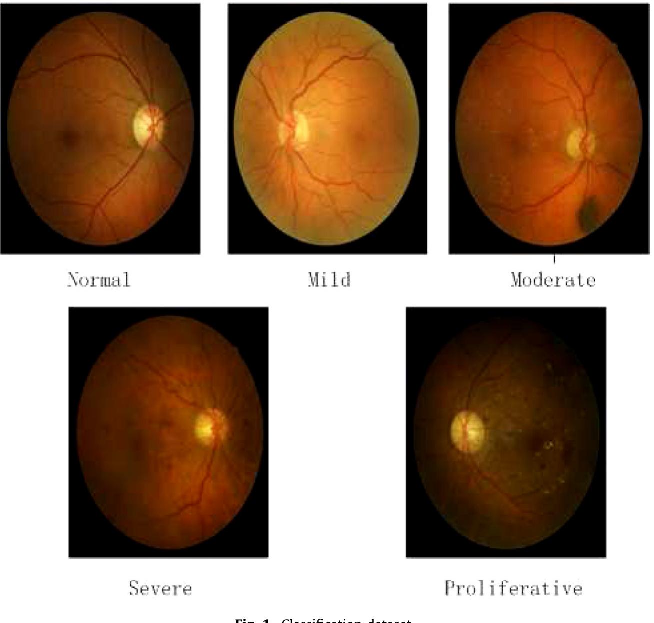 (PDF) Deep convolutional neural networks for diabetic retinopathy ...